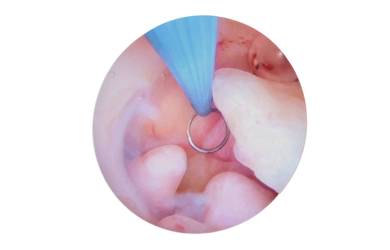 Gubbini Original Mini Hysteroscope - Image 6