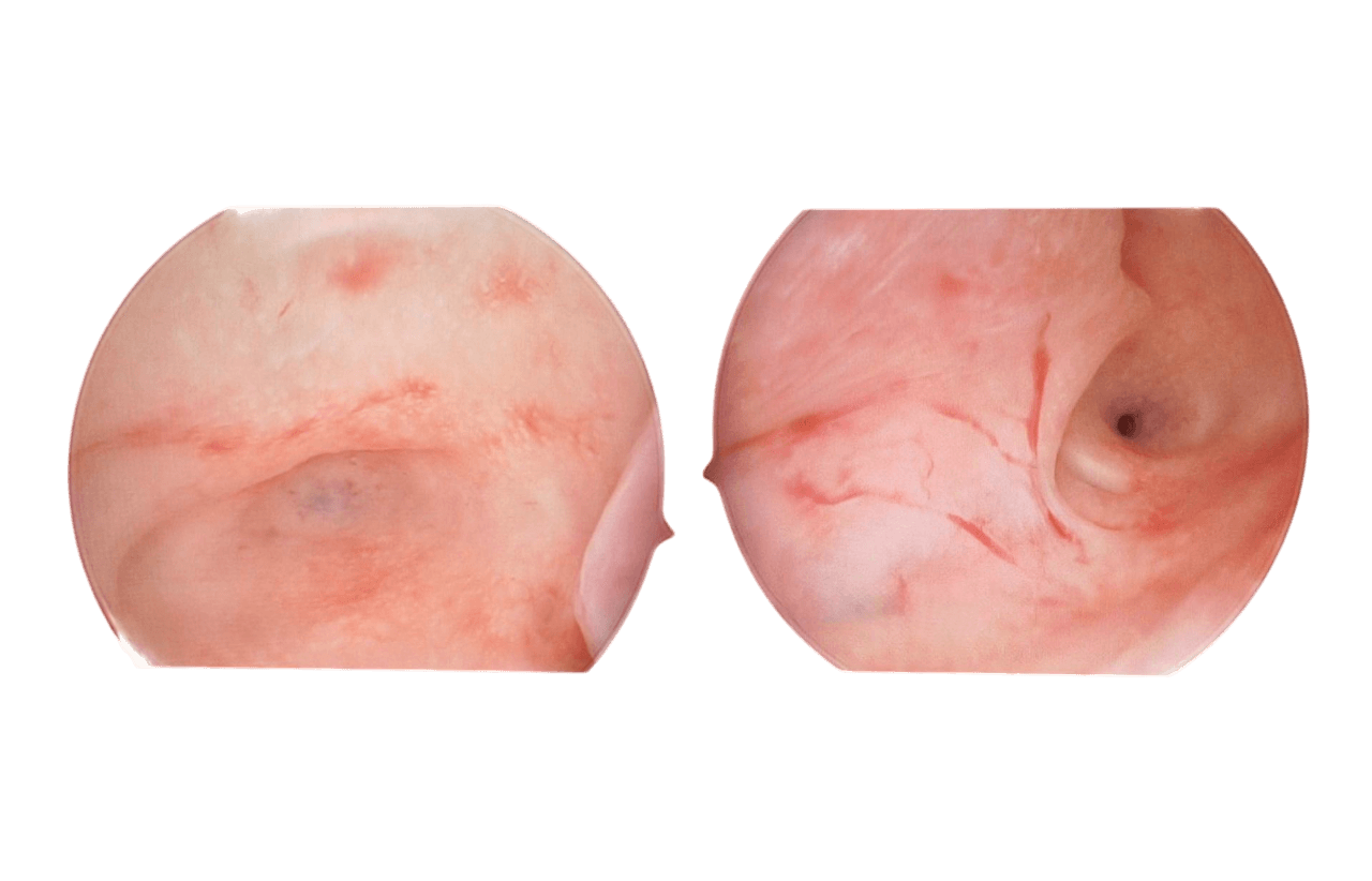 Gynko - disposable sheath for hysteroscopy - Image 4