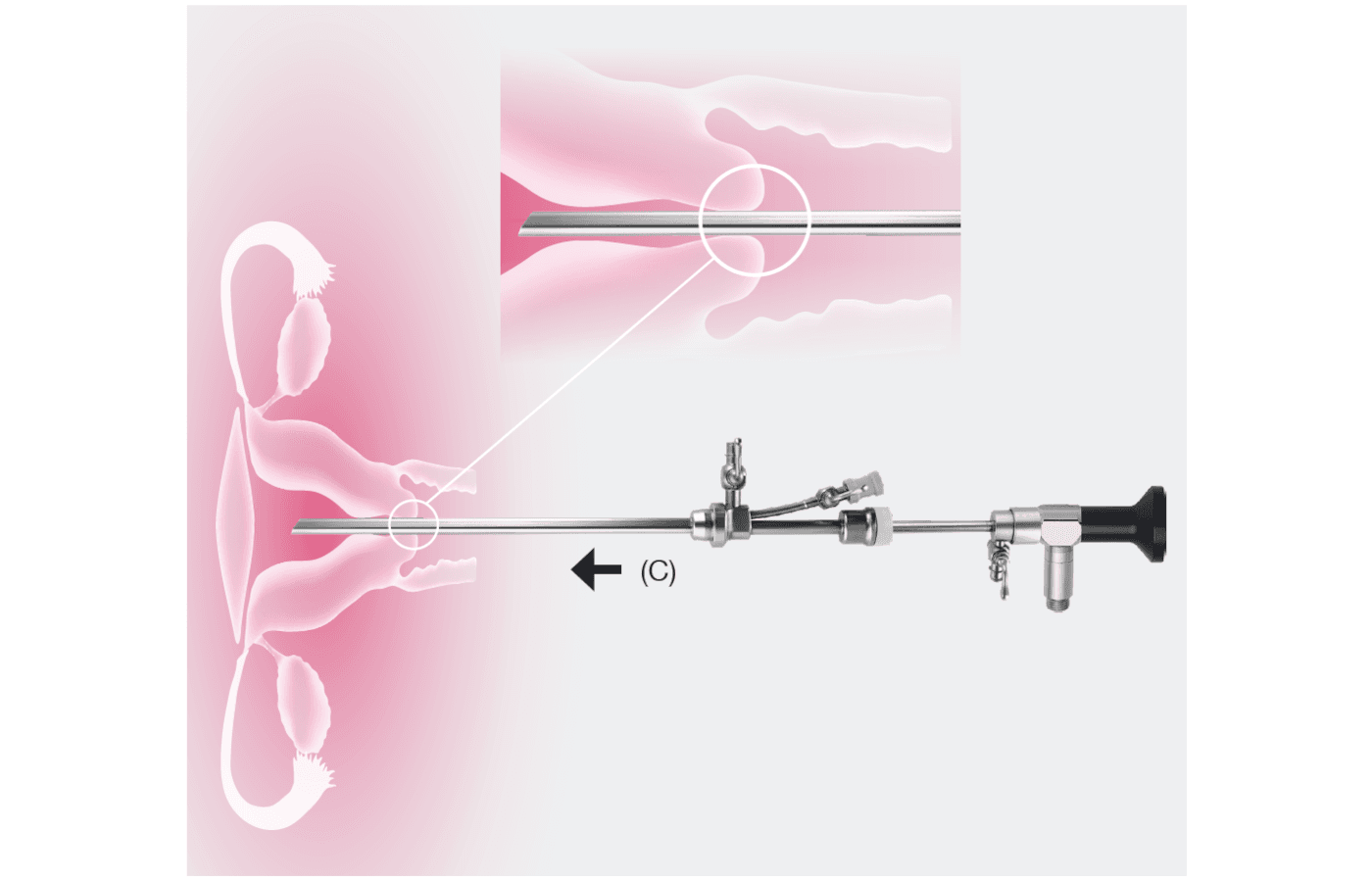 RAIS hysteroscope - Image 3